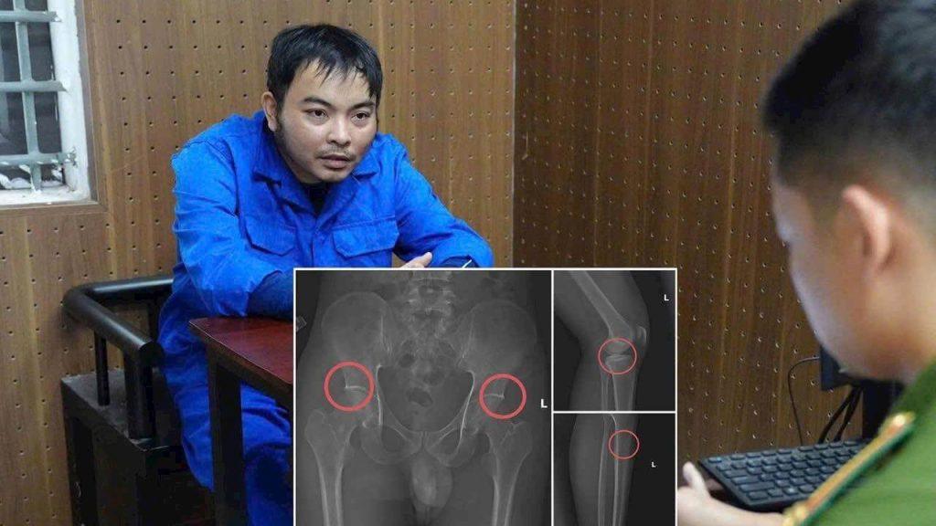 Tự đục vỡ xương để trục lợi 6 tỷ bảo hiểm