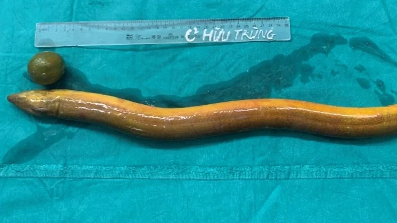 Dị vật được lấy ra khỏi cơ thể nam thanh niên