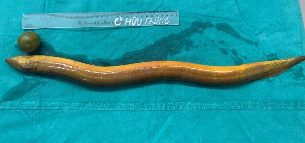 Dị vật được lấy ra khỏi cơ thể nam thanh niên